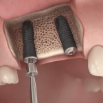 Implant Surgical 8