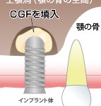 填入と埋入