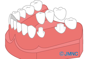 ブリッジ治療
