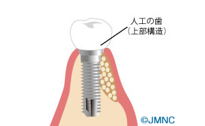 GBR法＝骨誘導再生法