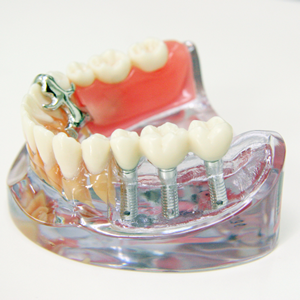 Step5：型取り・人工の歯の装着