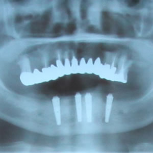 Step2：型どり（上下）・X線撮影・口腔内検査